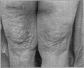 Class_V_Atrophies_Diffuse_Idiopathic_Atrophy_Of_The_Skin-1.jpg